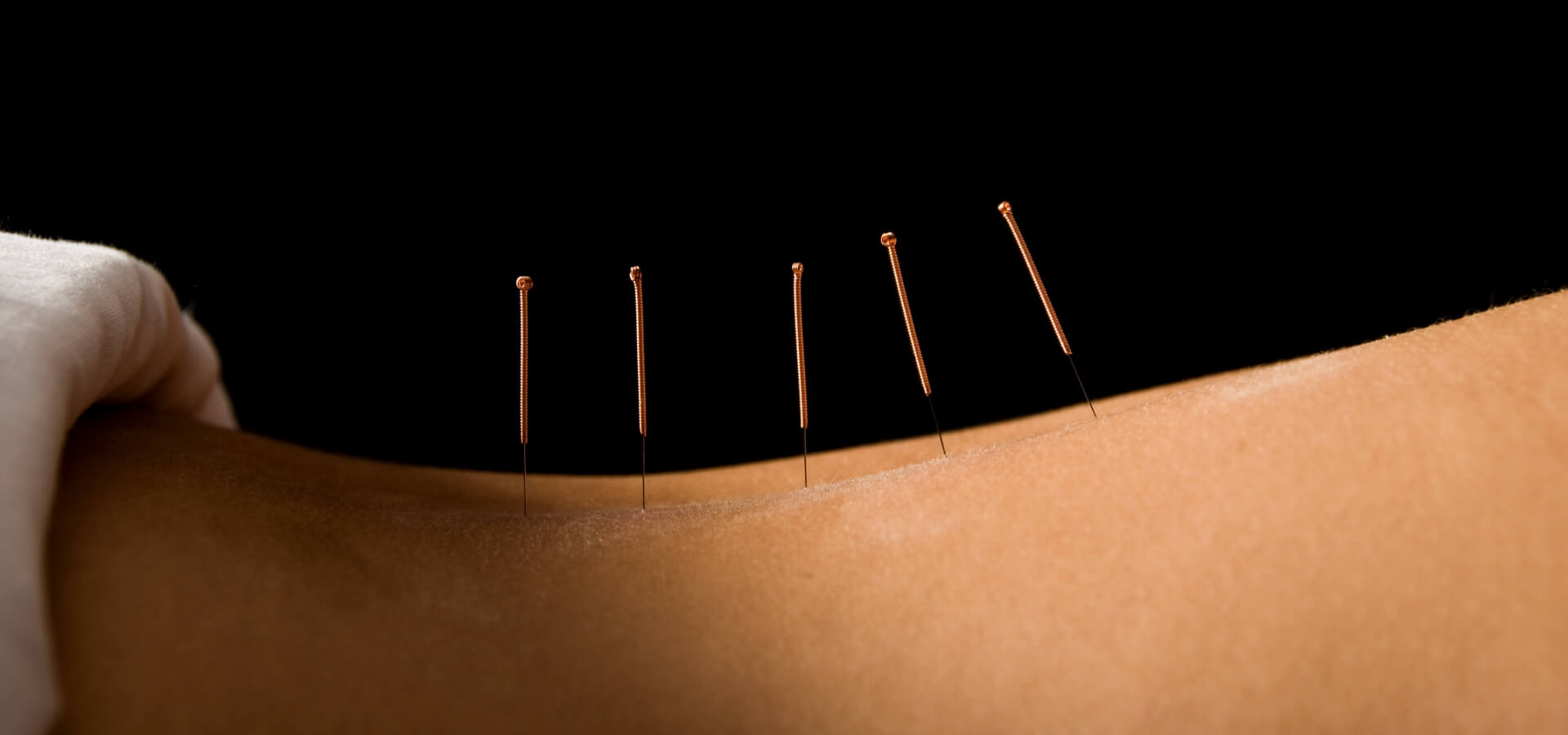 Acupuntura en Barcelona Salud integral desde la raíz